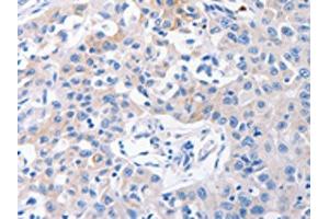 The image on the left is immunohistochemistry of paraffin-embedded Human lung cancer tissue using ABIN7192382(SLC10A1 Antibody) at dilution 1/31, on the right is treated with synthetic peptide. (SLC1A1 anticorps)