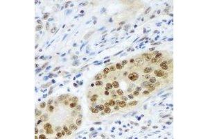 Immunohistochemical analysis of PSMB2 staining in human colon cancer formalin fixed paraffin embedded tissue section. (PSMB2 anticorps)