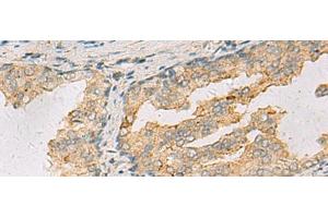 Immunohistochemistry of paraffin-embedded Human prost ate cancer tissue using ANXA13 Polyclonal Antibody at dilution of 1:105(x200)
