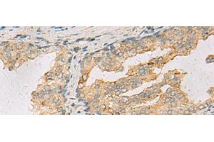 Immunohistochemistry of paraffin-embedded Human prost ate cancer tissue using ANXA13 Polyclonal Antibody at dilution of 1:105(x200) (Annexin A13 anticorps)