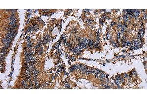 Immunohistochemistry of paraffin-embedded Human colon cancer using KRT31 Polyclonal Antibody at dilution of 1:30 (Keratin 31 anticorps)