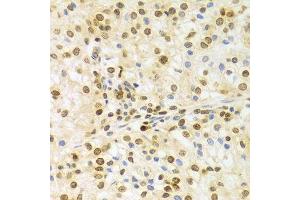 Immunohistochemistry of paraffin-embedded human kidney cancer using ELAVL1 Antibody.