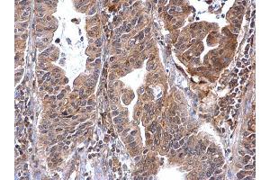 IHC-P Image Annexin VII antibody detects Annexin VII protein at cytosol on human gastric carcinoma by immunohistochemical analysis. (Annexin VII anticorps)