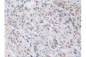 IHC-P analysis of Human Prostate Gland Cancer Tissue, with DAB staining. (NUP50 anticorps  (AA 37-269))