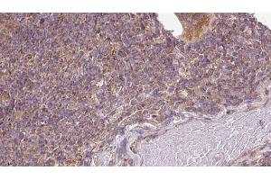 ABIN6273136 at 1/100 staining Human lymph cancer tissue by IHC-P. (DIAPH1 anticorps)