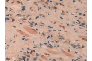 DAB staining on IHC-P; Samples: Human Prostate cancer Tissue