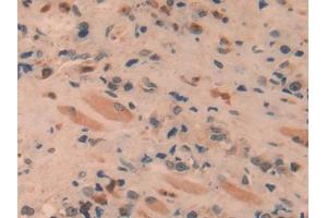DAB staining on IHC-P; Samples: Human Prostate cancer Tissue (SPRY1 anticorps  (AA 118-309))