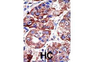 Formalin-fixed and paraffin-embedded human hepatocellular carcinoma tissue reacted with SQSTM1 polyclonal antibody  , which was peroxidase-conjugated to the secondary antibody, followed by DAB staining. (SQSTM1 anticorps  (C-Term))