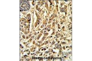 Formalin-fixed and paraffin-embedded human breast carcinoma reacted with CYP21A2 Antibody (C-term), which was peroxidase-conjugated to the secondary antibody, followed by DAB staining.
