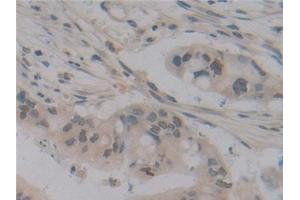 Detection of CYLD in Human Bile duct cancer Tissue using Polyclonal Antibody to Cylindromatosis (CYLD)