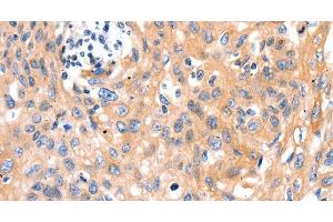 Immunohistochemistry of paraffin-embedded Human cervical cancer using MYL9 Polyclonal Antibody at dilution of 1:80
