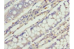 Immunohistochemistry of paraffin-embedded human colon cancer using ABIN7147039 at dilution of 1:100 (Cation Channel Sperm-Associated Protein Subunit epsilon (CATSPERE) (AA 601-832) anticorps)