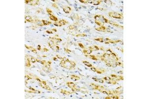 Immunohistochemistry of paraffin-embedded human liver cancer using FLT3 antibody (ABIN6134576, ABIN6140691, ABIN6140694 and ABIN6216061) at dilution of 1:100 (40x lens). (FLT3 anticorps  (AA 650-750))