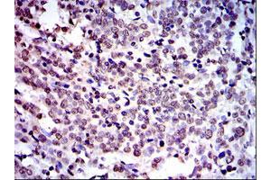 Immunohistochemical analysis of paraffin-embedded human cervical cancer tissues using NEDD8 monoclonal antibody, clone 1A7  with DAB staining. (NEDD8 anticorps)