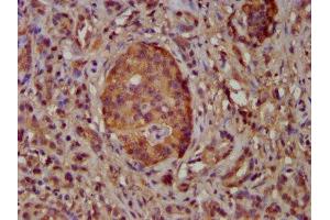 IHC image of ABIN7169106 diluted at 1:100 and staining in paraffin-embedded human pancreatic cancer performed on a Leica BondTM system. (NEK5 anticorps  (AA 372-468))