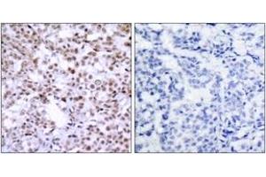 Immunohistochemistry analysis of paraffin-embedded human breast carcinoma, using Chk2 (Ab-68) Antibody. (CHEK2 anticorps  (AA 35-84))