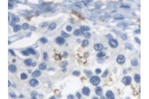 Detection of ARSA in Human Prostate cancer Tissue using Polyclonal Antibody to Arylsulfatase A (ARSA) (Arylsulfatase A anticorps)