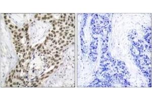 Immunohistochemistry analysis of paraffin-embedded human prostate carcinoma, using Androgen Receptor (Phospho-Ser213) Antibody. (Androgen Receptor anticorps  (pSer213))
