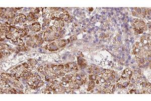 ABIN6279672 at 1/100 staining Human liver cancer tissue by IHC-P. (Plexin A2 anticorps  (Internal Region))