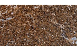 Immunohistochemistry of paraffin-embedded Human ovarian cancer tissue using KDM4B Polyclonal Antibody at dilution 1:50 (KDM4B anticorps)