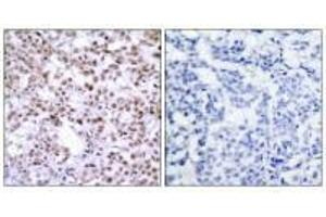 Immunohistochemistry analysis of paraffin-embedded human breast carcinoma, using Chk2 (Ab-68) antibody.