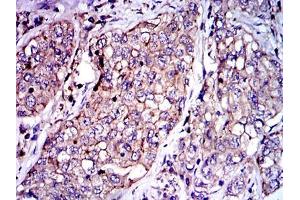 Immunohistochemical analysis of paraffin-embedded lung cancer tissues using SERPINE1 mouse mAb with DAB staining. (PAI1 anticorps)