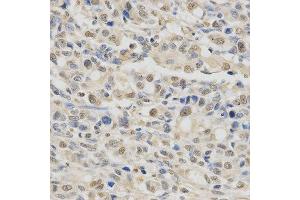 Immunohistochemistry of paraffin-embedded human stomach cancer using SPHK1 antibody at dilution of 1:200 (x400 lens). (SPHK1 anticorps)