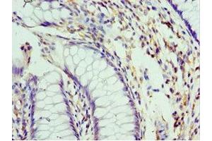 Immunohistochemistry of paraffin-embedded human colon cancer using ABIN7151101 at dilution of 1:100 (Pellino 1 anticorps  (AA 1-250))