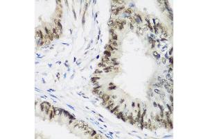 Immunohistochemistry of paraffin-embedded human colon carcinoma using AEBP2 antibody at dilution of 1:200 (40x lens). (AEBP2 anticorps)