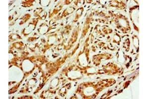 Immunohistochemistry of paraffin-embedded human breast cancer using ABIN7143462 at dilution of 1:100