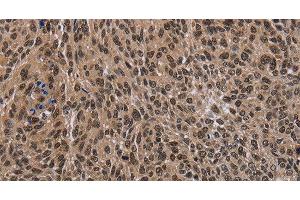 Immunohistochemistry of paraffin-embedded Human lung cancer tissue using DLX4 Polyclonal Antibody at dilution 1:50 (DLX4 anticorps)