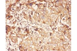 IHC-P: ALOX15 antibody testing of human breast cancer tissue (ALOX15 anticorps  (AA 2-337))