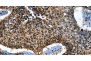 Immunohistochemistry of paraffin-embedded Human lung cancer tissue using CACNB2 Polyclonal Antibody at dilution 1:30
