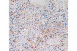 IHC-P analysis of Human Glioma Tissue, with DAB staining. (CRYAB anticorps  (AA 1-175))