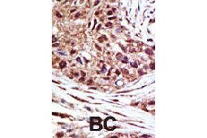 Formalin-fixed and paraffin-embedded human cancer tissue reacted with USP14 polyclonal antibody  , which was peroxidase-conjugated to the secondary antibody, followed by AEC staining . (USP14 anticorps  (N-Term))