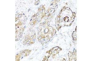 Immunohistochemistry of paraffin-embedded human prostate cancer using NRG4 antibody at dilution of 1:100 (40x lens). (Neuregulin 4 anticorps)