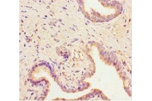 Immunohistochemistry of paraffin-embedded human prostate cancer using ABIN7168723 at dilution of 1:100 (SCAMP2 anticorps  (AA 1-153))