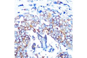 Immunohistochemistry of paraffin-embedded human breast cancer using HD Rabbit mAb (ABIN7267711) at dilution of 1:100 (40x lens).