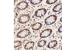 Immunohistochemistry of paraffin embedded human colon cancer using PAX2 (ABIN7074974) at dilution of 1:1000 (300x lens)