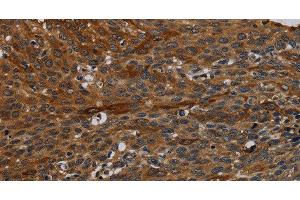 Immunohistochemistry of paraffin-embedded Human cervical cancer tissue using IVL Polyclonal Antibody at dilution 1:50