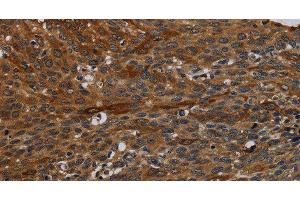 Immunohistochemistry of paraffin-embedded Human cervical cancer tissue using IVL Polyclonal Antibody at dilution 1:50 (Involucrin anticorps)