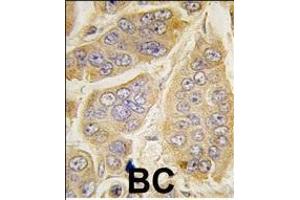 Formalin-fixed and paraffin-embedded human breast carcinoma tissue reacted with NANOS1 antibody (C-term) (ABIN388159 and ABIN2846945) , which was peroxidase-conjugated to the secondary antibody, followed by DAB staining. (Nanos Homolog 1 anticorps  (C-Term))