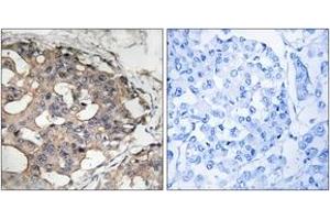 Immunohistochemistry analysis of paraffin-embedded human breast carcinoma tissue, using B-RAF (Ab-446) Antibody. (SNRPE anticorps  (AA 411-460))