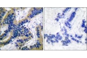 Immunohistochemistry analysis of paraffin-embedded human lung carcinoma tissue, using Caspase 6 (Cleaved-Asp162) Antibody. (Caspase 6 anticorps  (Cleaved-Asp162))
