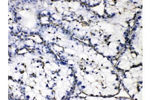 GAA was detected in paraffin-embedded sections of human liver cancer tissues using rabbit anti- GAA Antigen Affinity purified polyclonal antibody (Catalog # ) at 1 µg/mL.