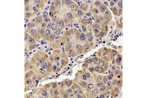 Immunohistochemical analysis of KIF1B staining in human liver cancer formalin fixed paraffin embedded tissue section. (KIF1B anticorps)