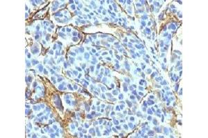 Formalin-fixed, paraffin-embedded human melanoma stained with NGFR antibody (NTR/912). (NGFR anticorps)