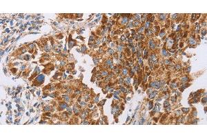 Immunohistochemistry of paraffin-embedded Human lung cancer tissue using GUCY1A3 Polyclonal Antibody at dilution 1:40 (GUCY1A1 anticorps)