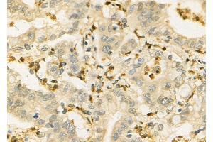 ABIN6257277 and ABIN6275882 at 1/100 staining Human colorectal cancer by IHC-P.