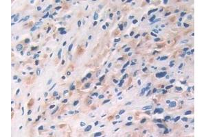 Detection of IL33 in Human Prostate cancer Tissue using Monoclonal Antibody to Interleukin 33 (IL33)